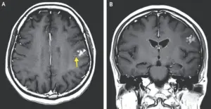 Medical Case Report Details How a Parasitic Infection Caused Sudden Seizures in a Farmer’s Brain