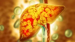 Cedars-Sinai Researchers Identify Key Enzyme That Protects Against Advanced Fatty Liver Disease