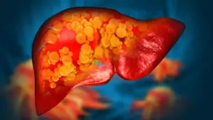 Experimental Drug Developed at Michigan Medicine Reverses Severe Fatty Liver Disease by Healing the Gut
