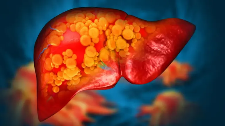Experimental Drug Developed at Michigan Medicine Reverses Severe Fatty Liver Disease by Healing the Gut