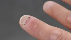 Study Links GLP-1 Medications to Increased Incidence of Nail Detachment and Scalp Inflammation
